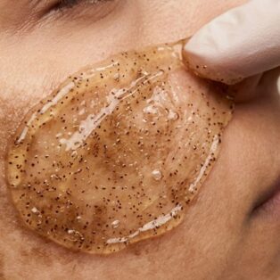Melasma D-Tan Treatment 1