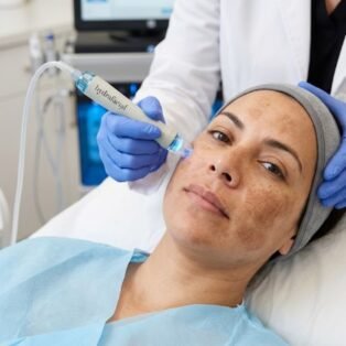 Melasma HydraFacial